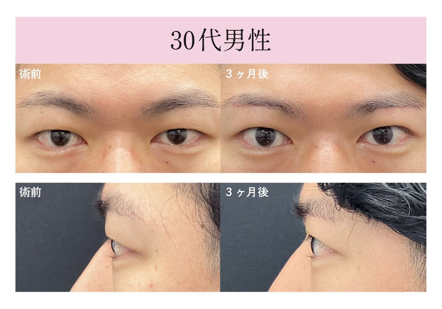 厚ぼったいまぶたを解消したい