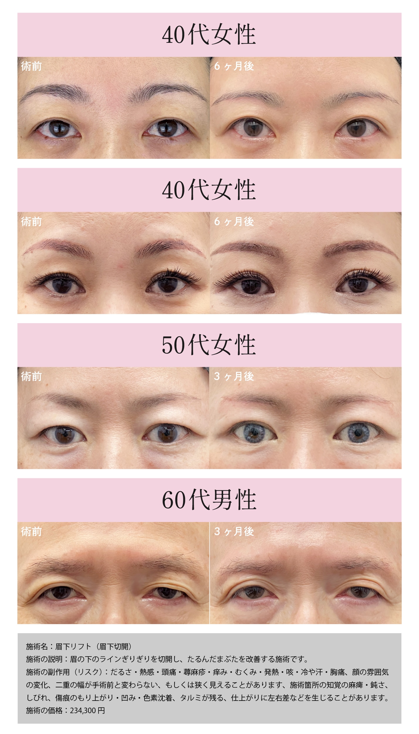 眉下リフトの症例写真