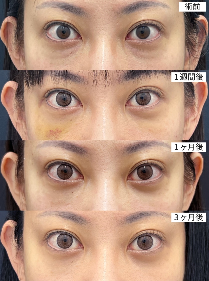 症例2｜40代女性（術前→1週間→1ヶ月→3ヶ月）