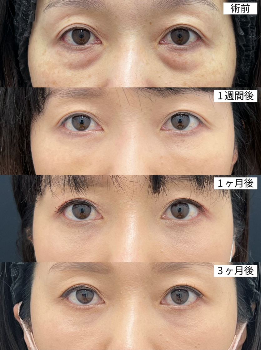 症例1｜40代女性（術前→1週間→1ヶ月→3ヶ月）