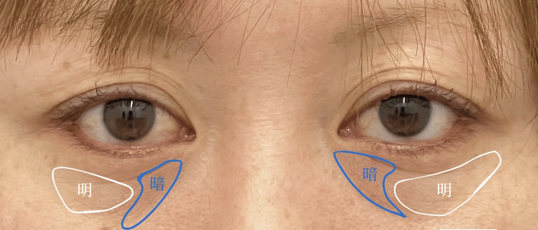 目の下の切らないクマたるみ取りだけして欲しいのにできないって言われるのはなんで？