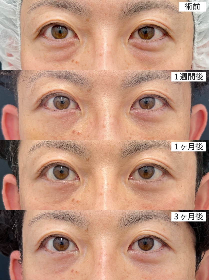 症例3｜40代男性（術前→1週間→1ヶ月→3ヶ月）