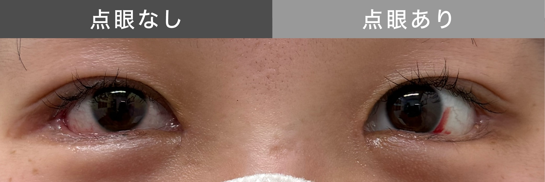 二重整形後のダウンタイムにもおすすめ