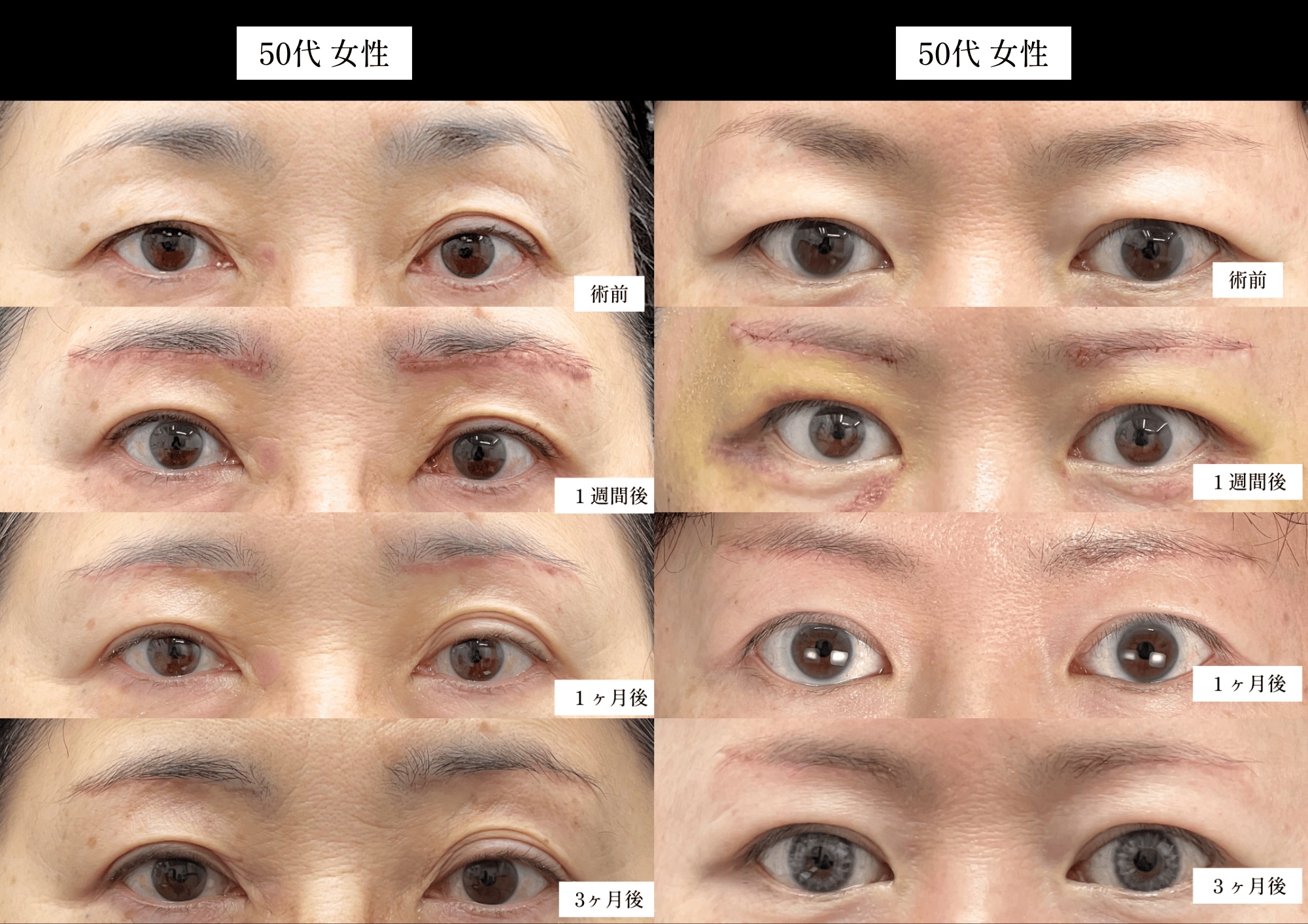 50代女性　眉下リフトのみ