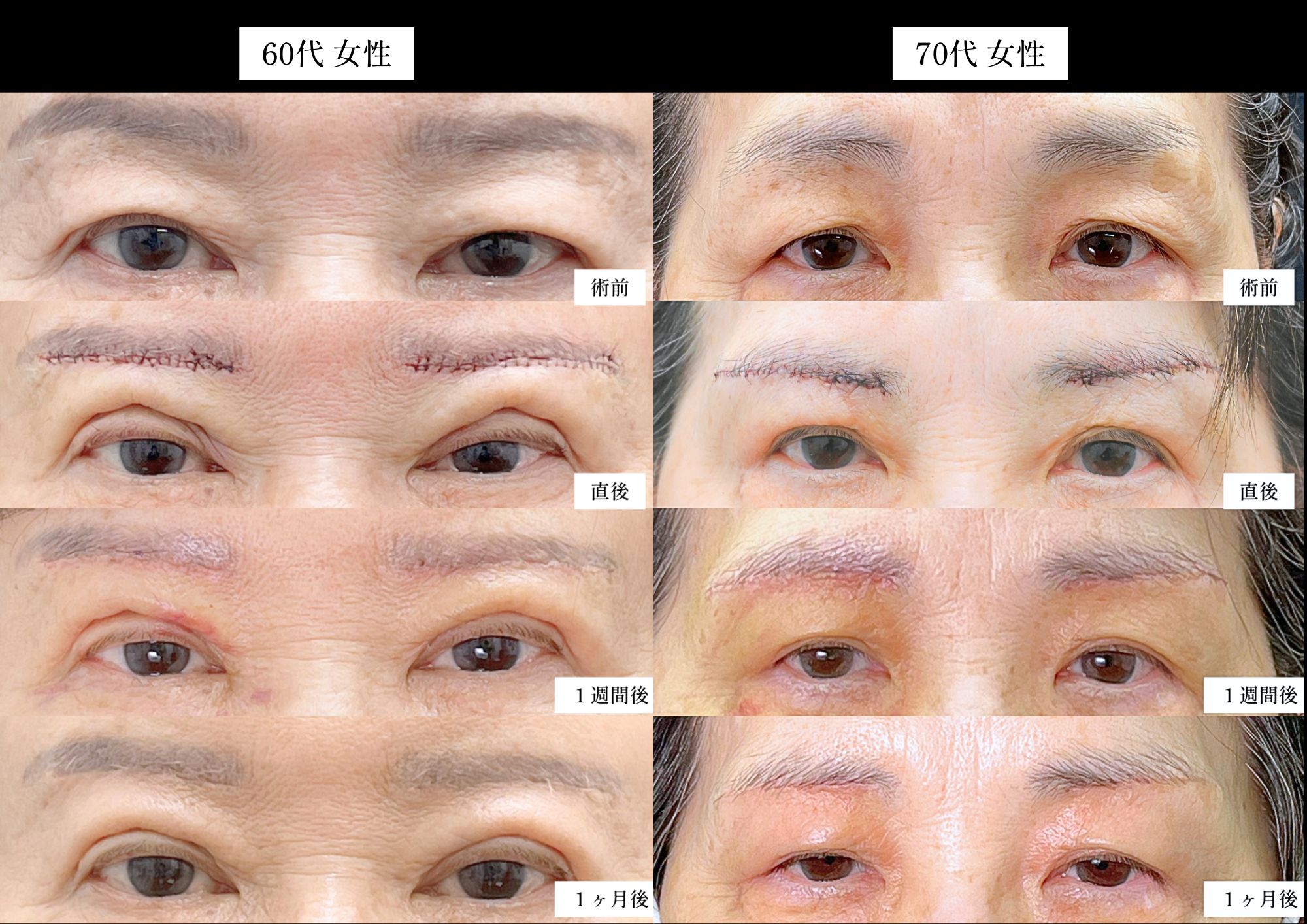 67歳女性　眉下リフト＋埋没(線留めクロス)<br />
70代女性　眉下リフト