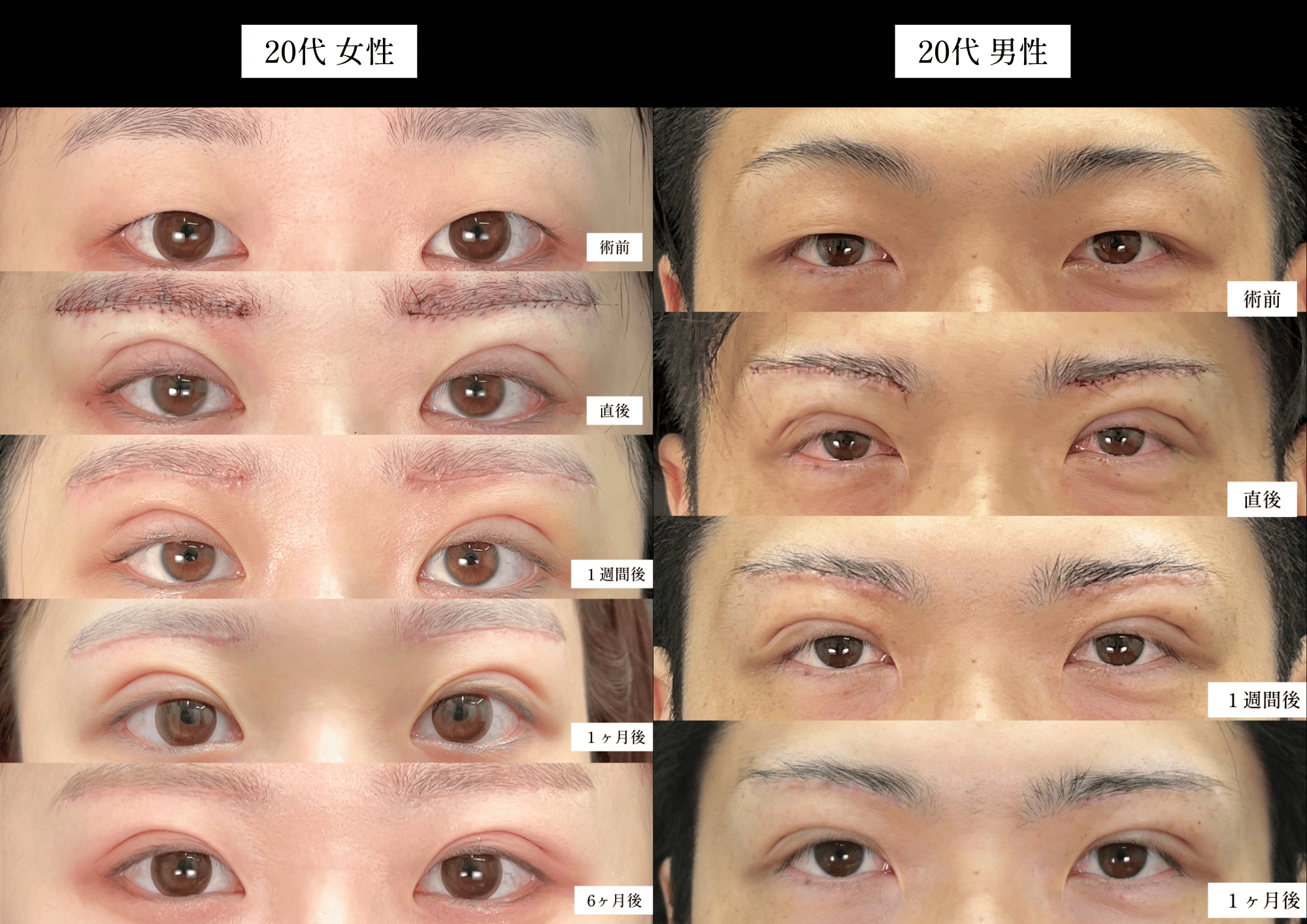 20代女性　20代男性<br />
眉下リフト＋埋没二重術(線留めクロス法)