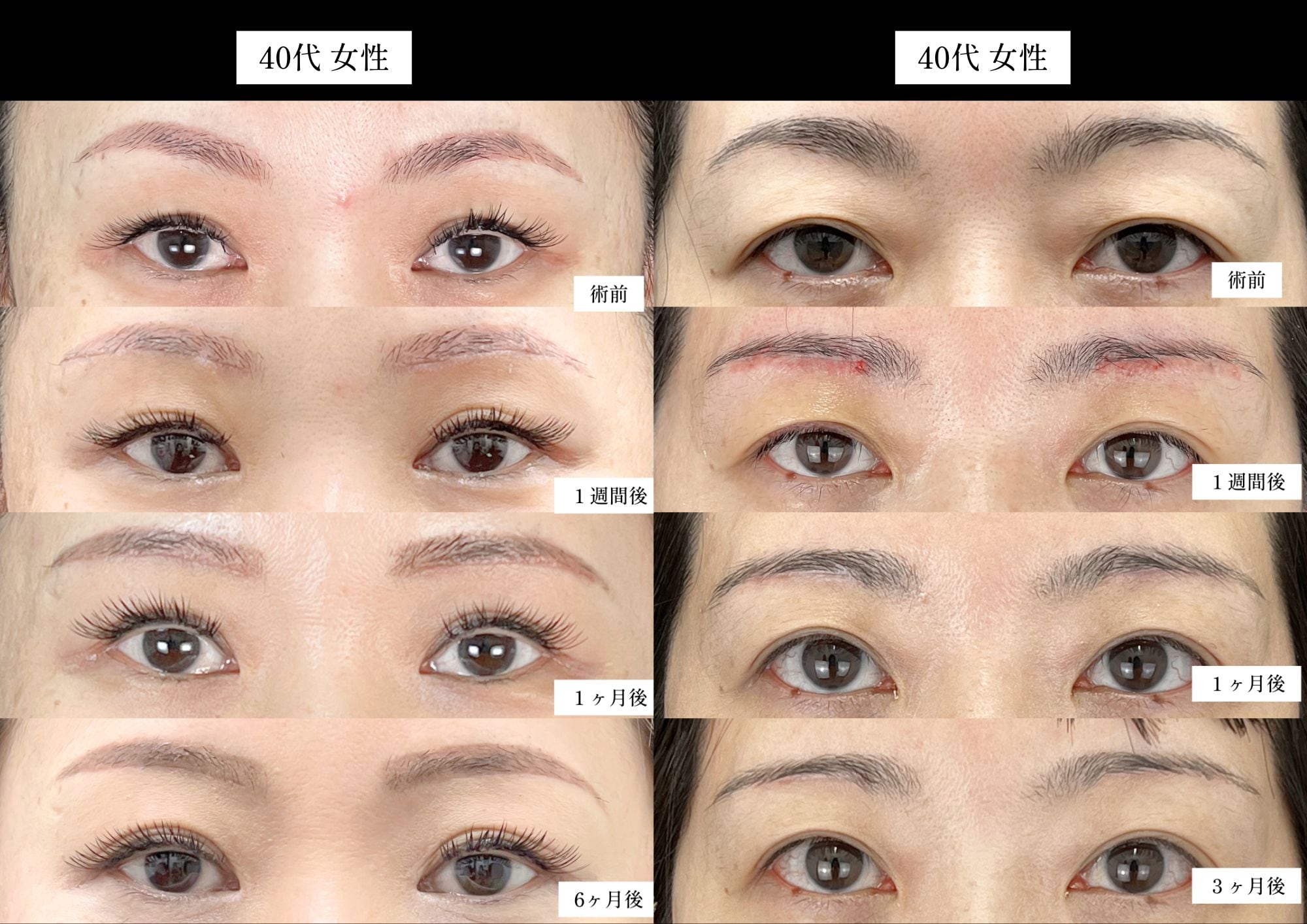 40代女性　眉下リフトのみ
