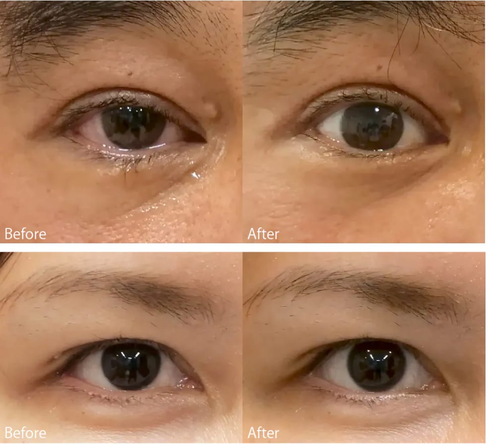 点眼10分後に効果が…！