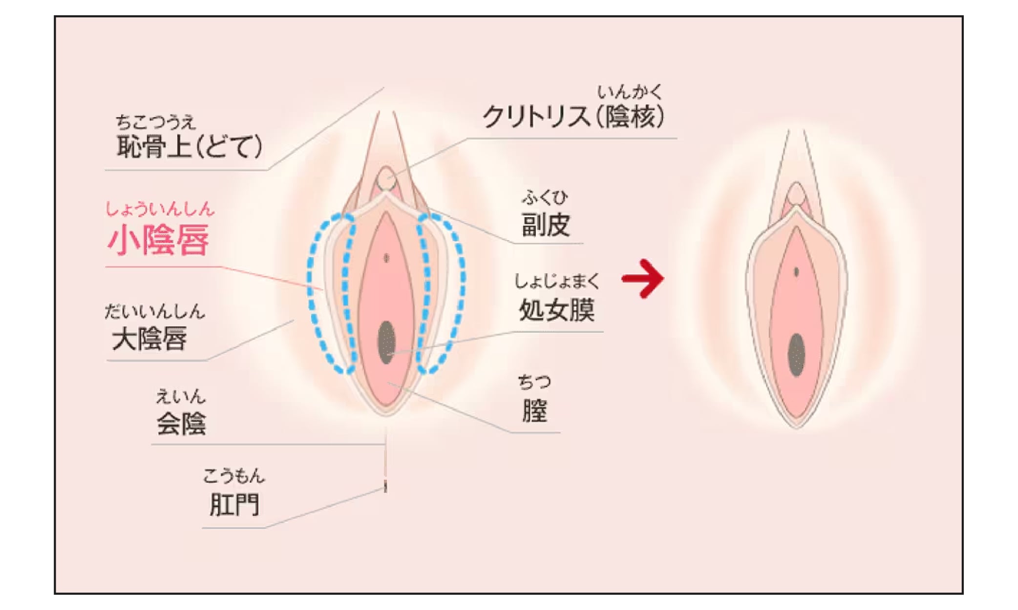 小陰唇縮小術