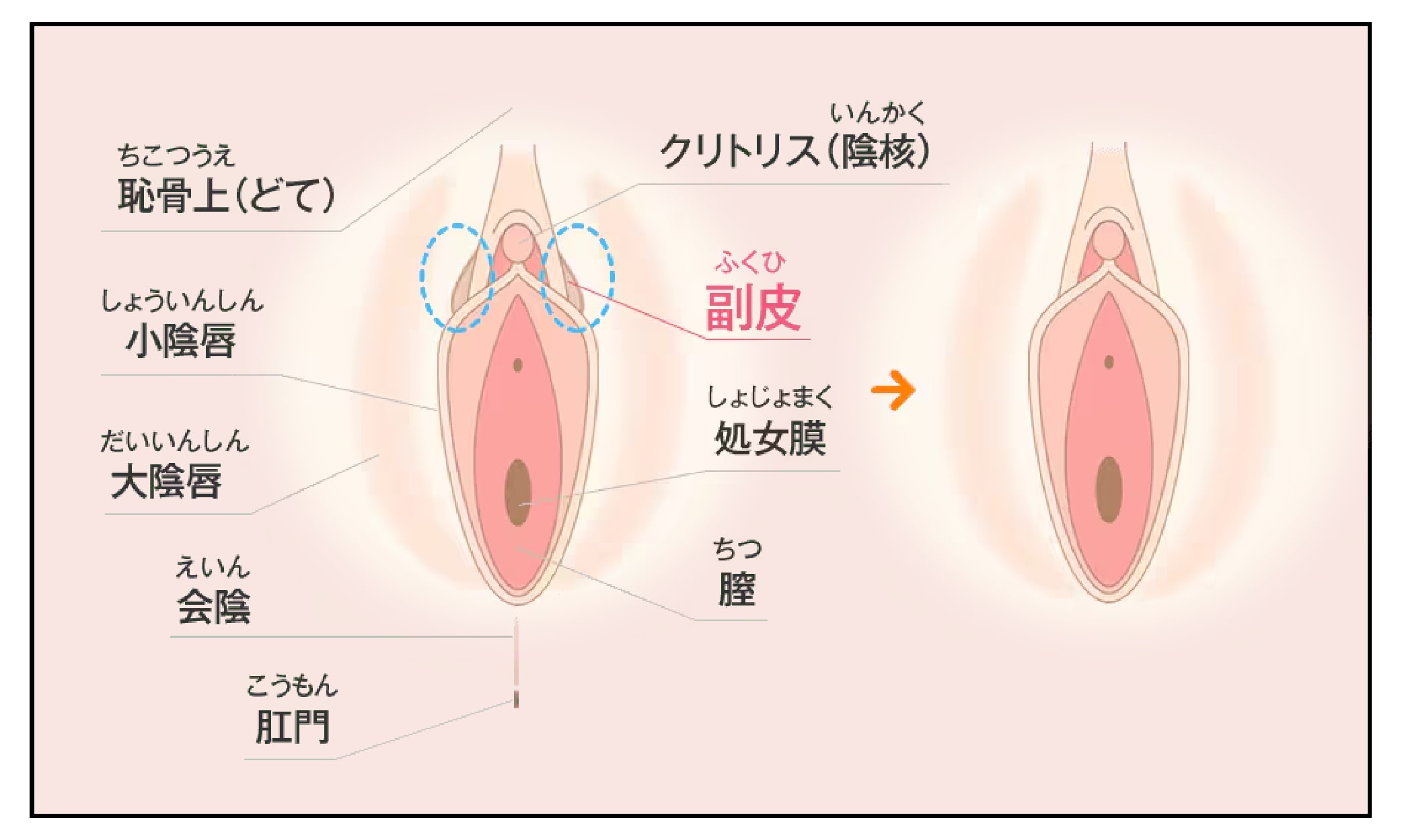 副皮除去術
