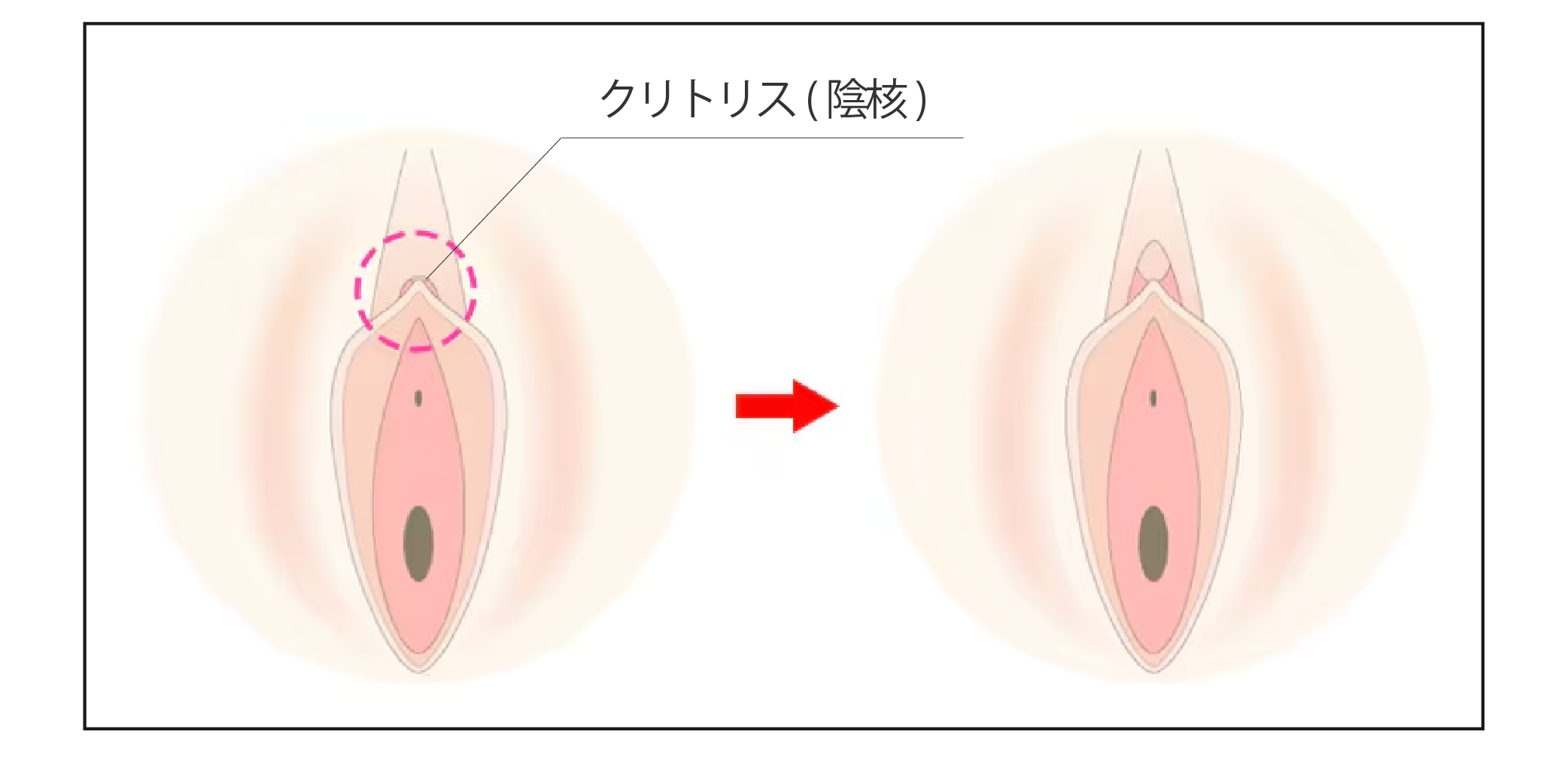 陰核(クリトリス)包茎術