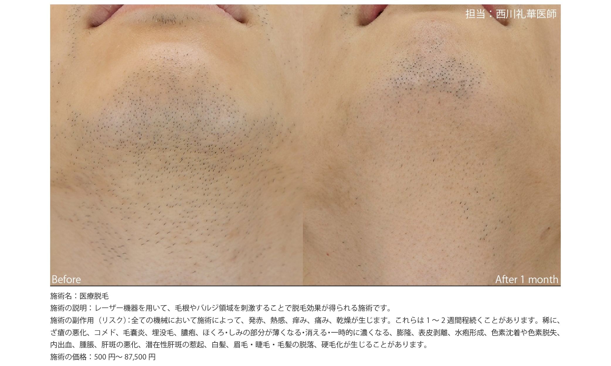 川口院の医療脱毛