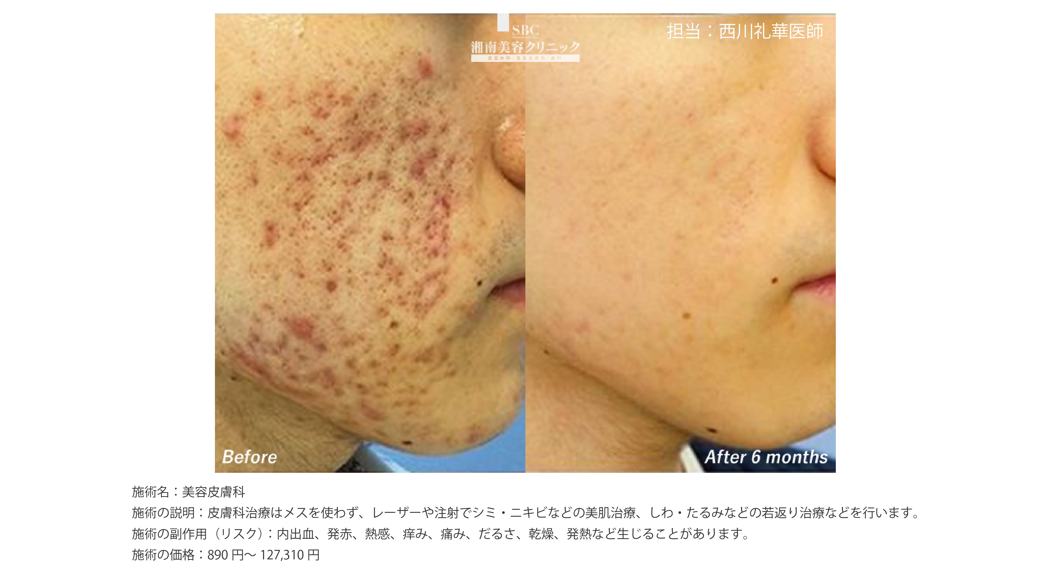 川口院のニキビ・ニキビ跡治療