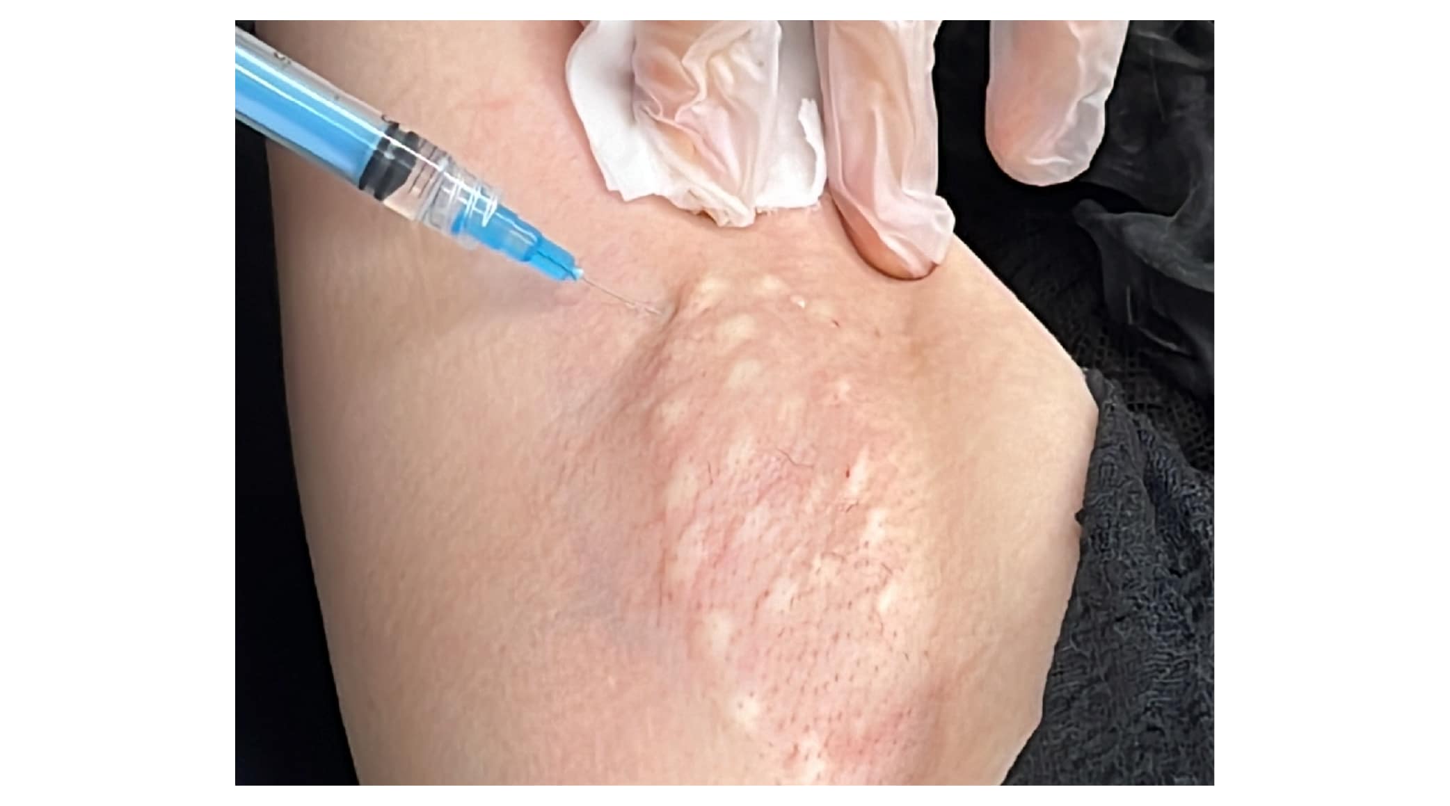 ワキ汗ボトックス