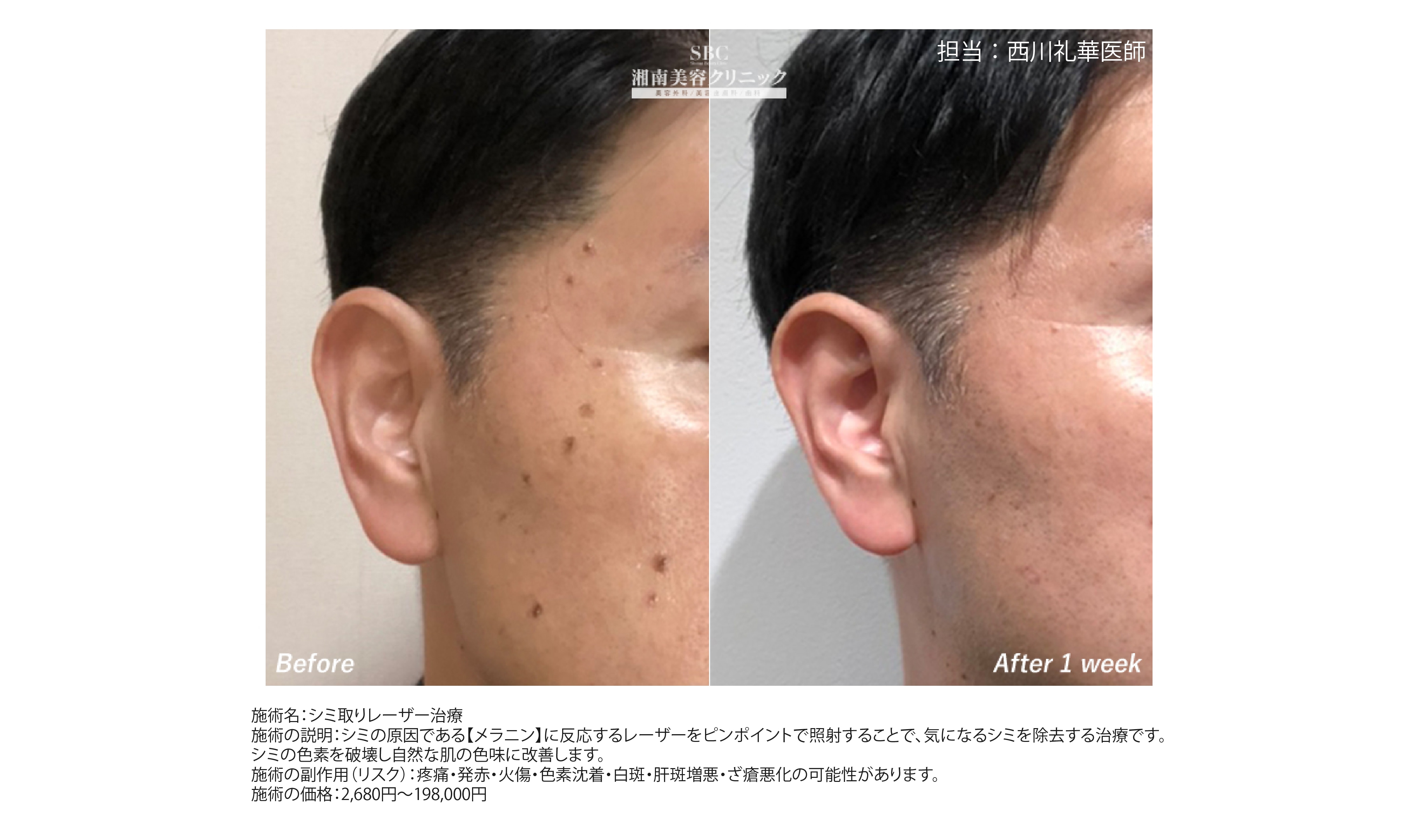 気になるシミを撃退