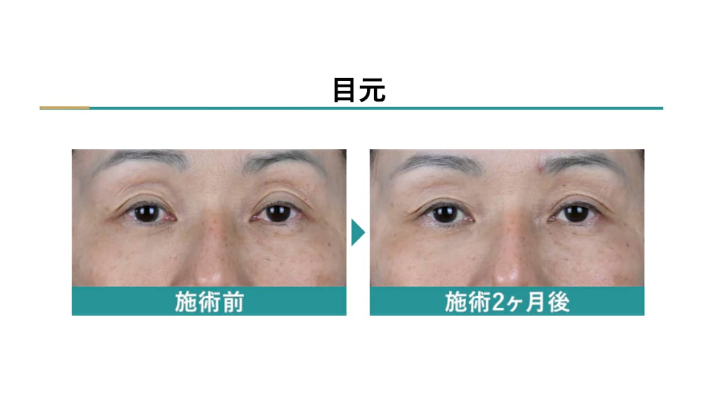 瞼