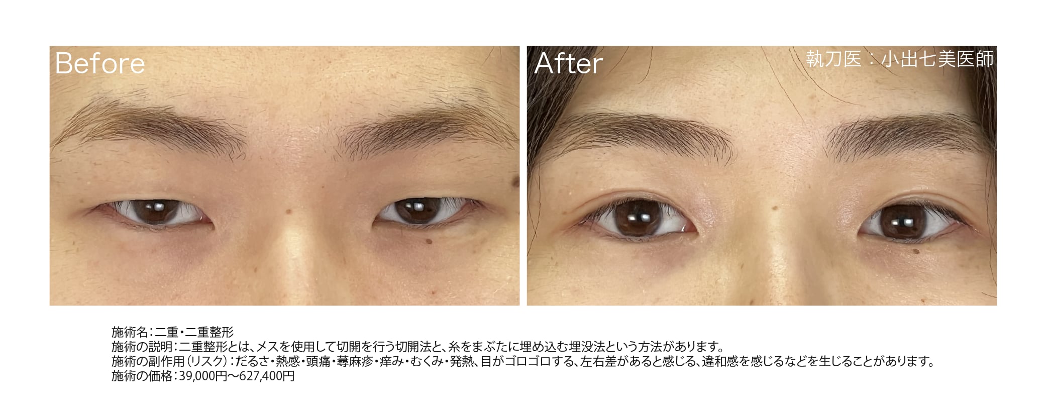 二重整形で垢抜け