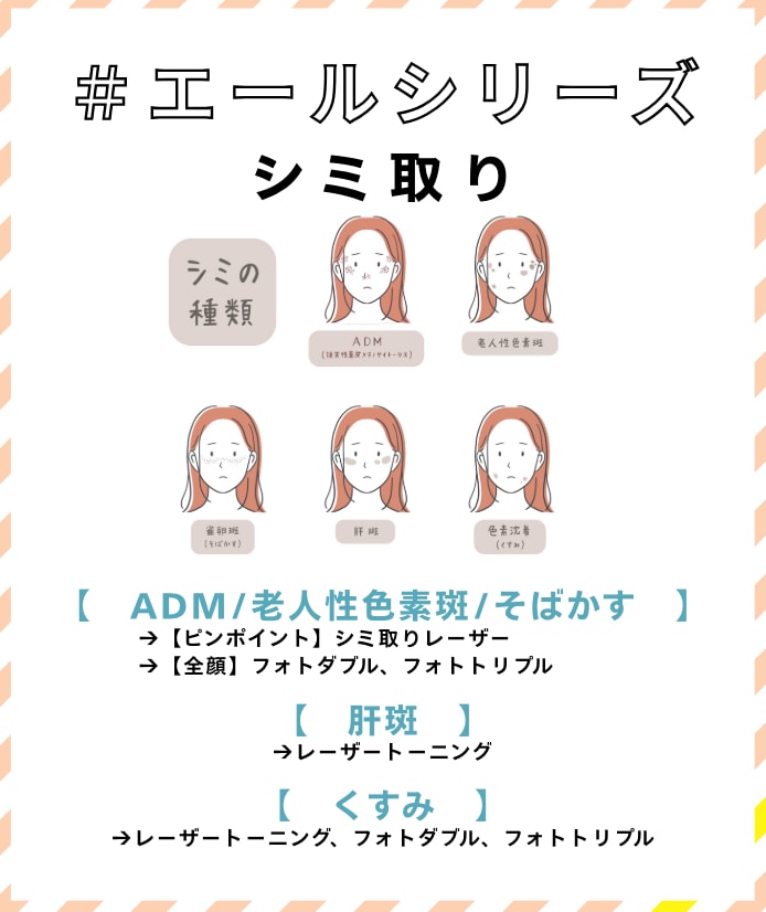 シミの原因と種類