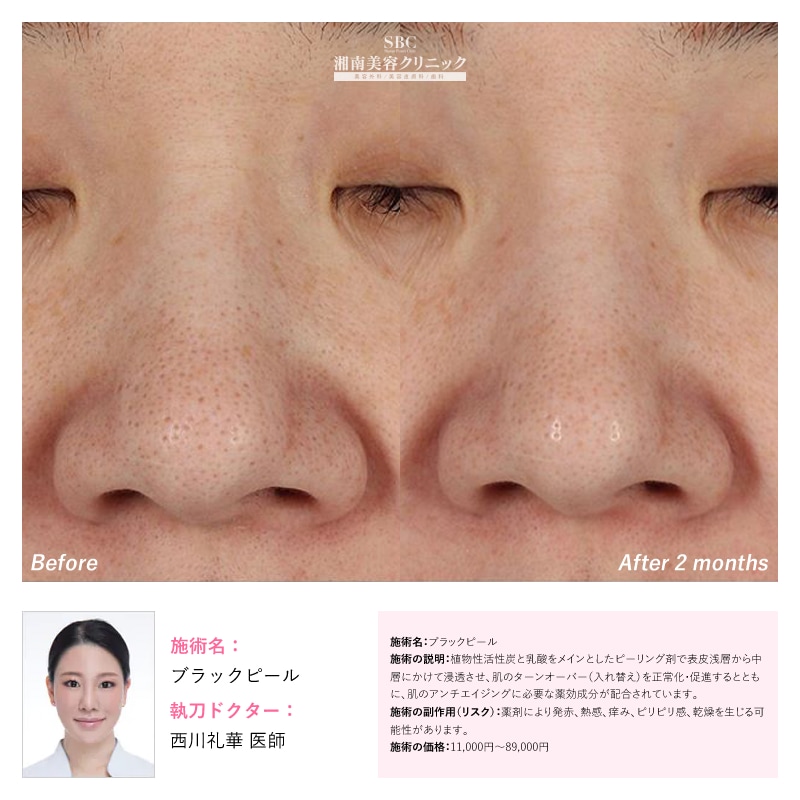 ブラックピール