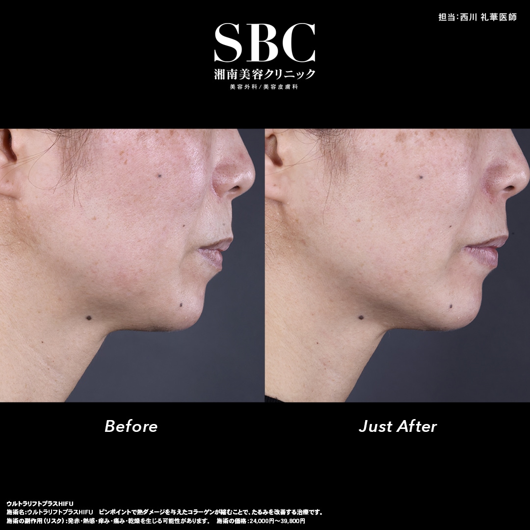 ウルトラリフト　プラスHIFU