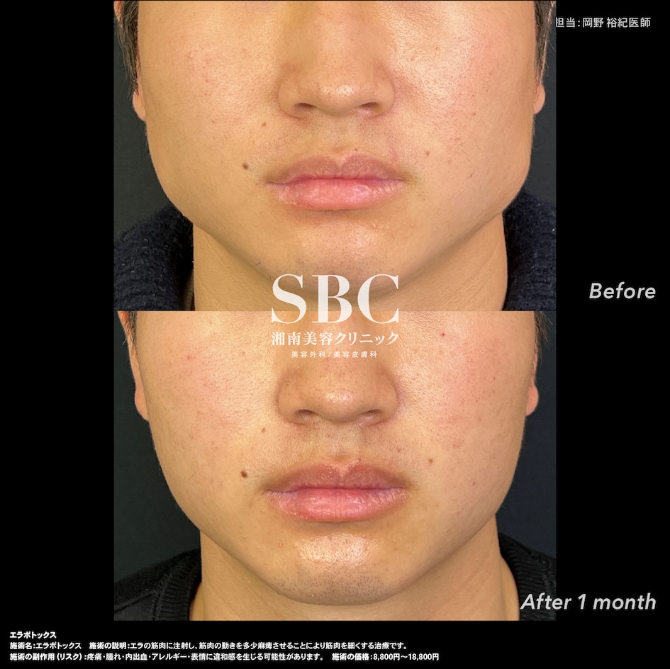 エラボトックス