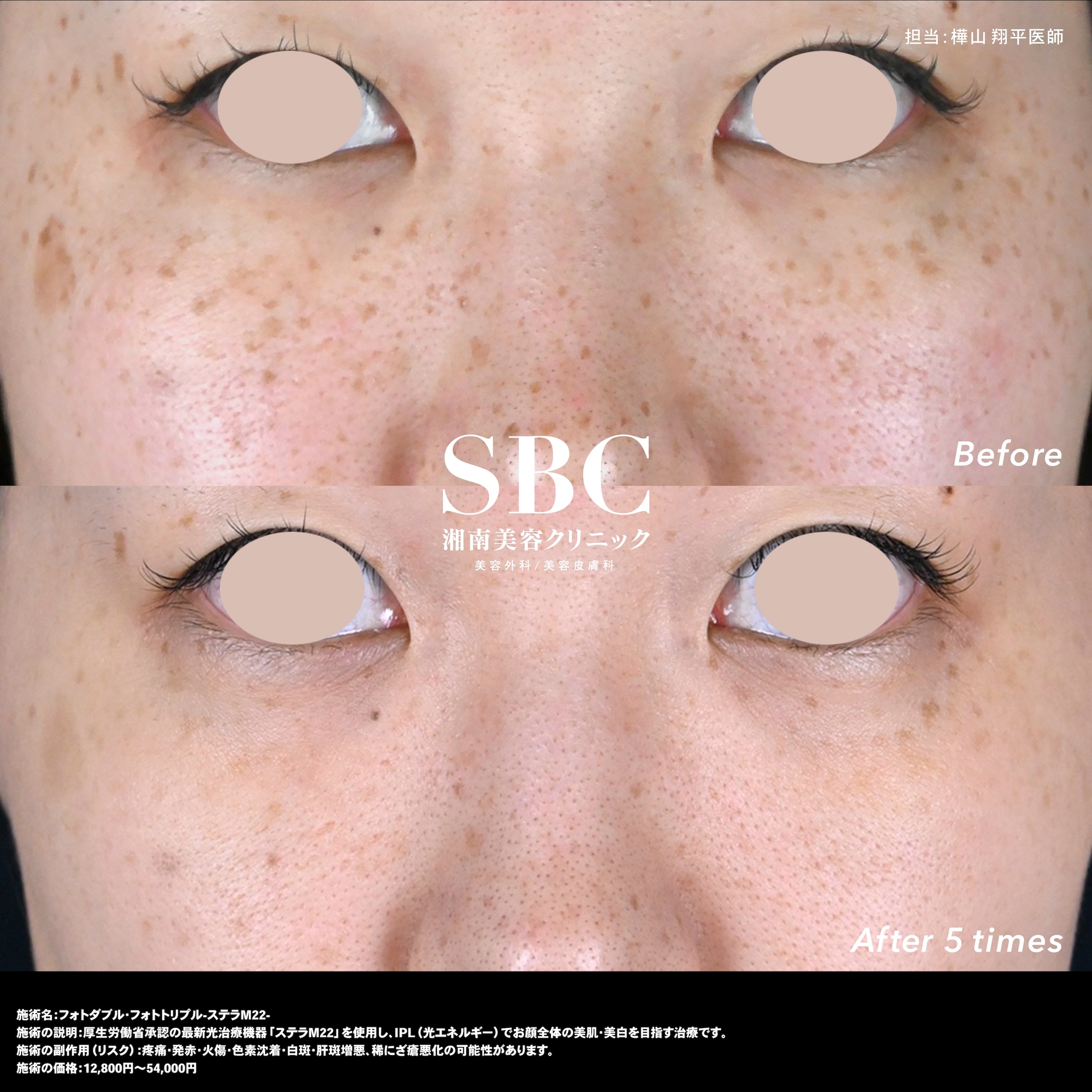 フォトトリプル