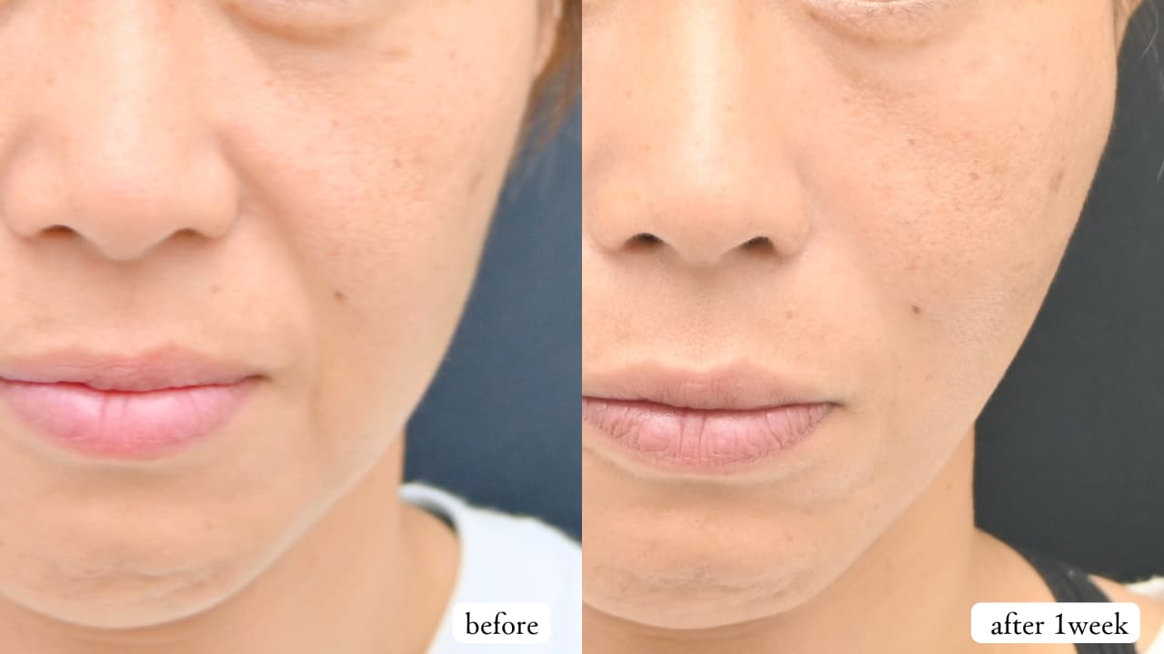 シークレットリフト10本(右頬5本左頬5本)