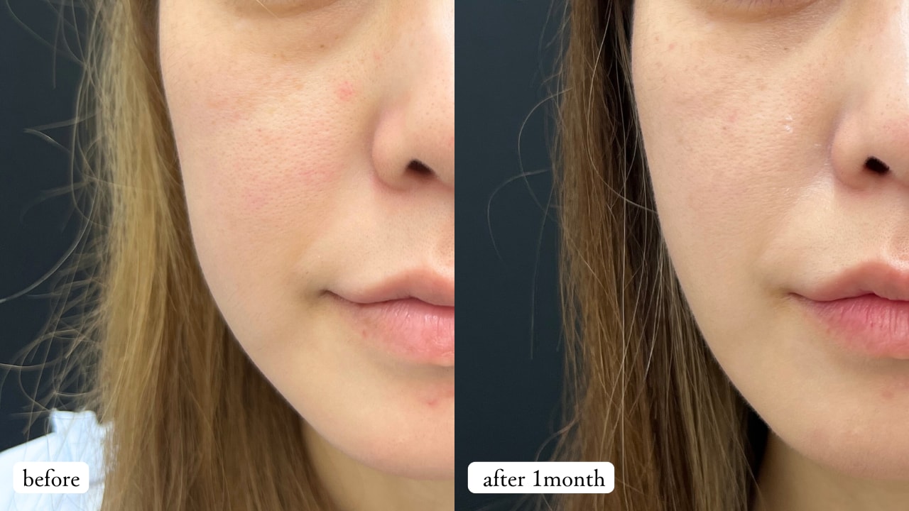 プリマリフト6本(右頬３本左頬３本)