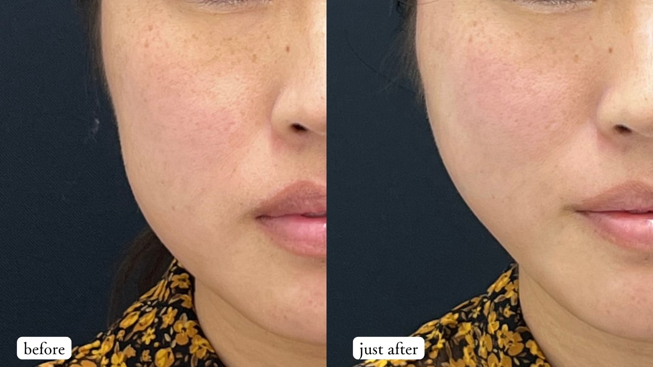 プリマリフト10本(右頬5本左頬5本)