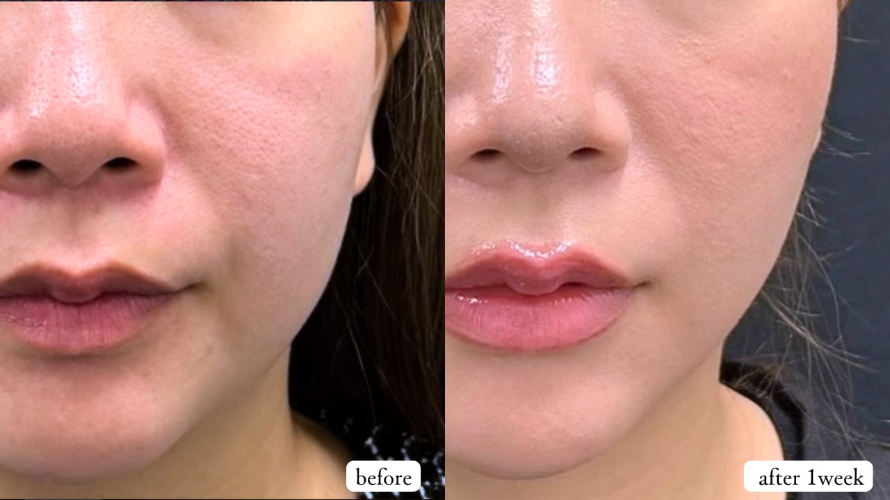 プリマリフト6本(片側３本ずつ)