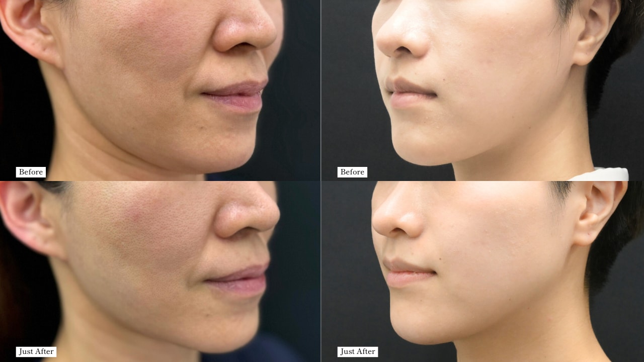 デンシティ症例