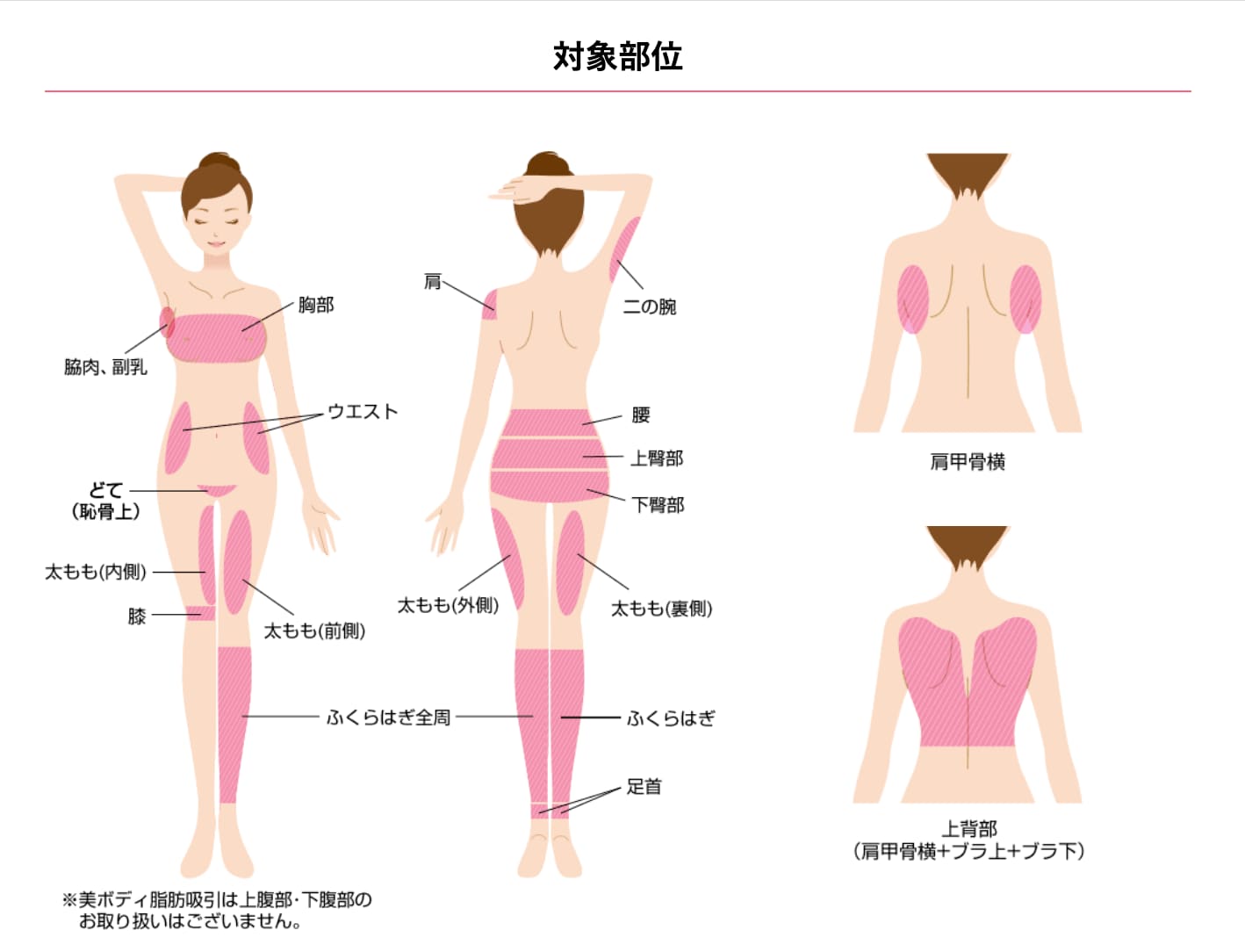 脂肪吸引のメリット②“部分痩せ”に最も向いている