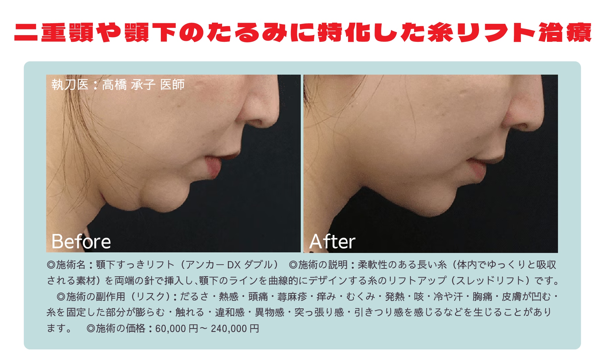 『顎下すっきリフト（アンカーDXダブル）』とは