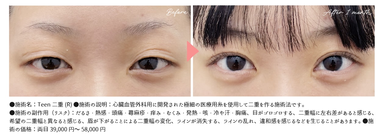 湘南美容クリニックの人気埋没二重術