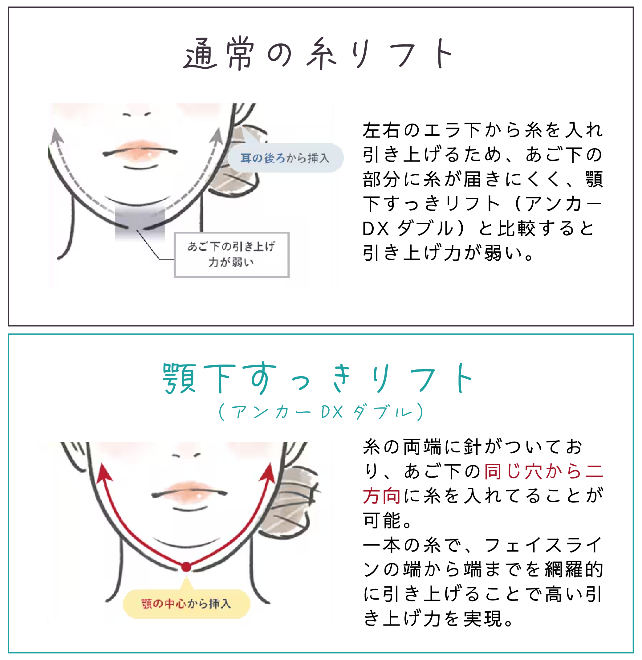 他の糸リフトとの違い