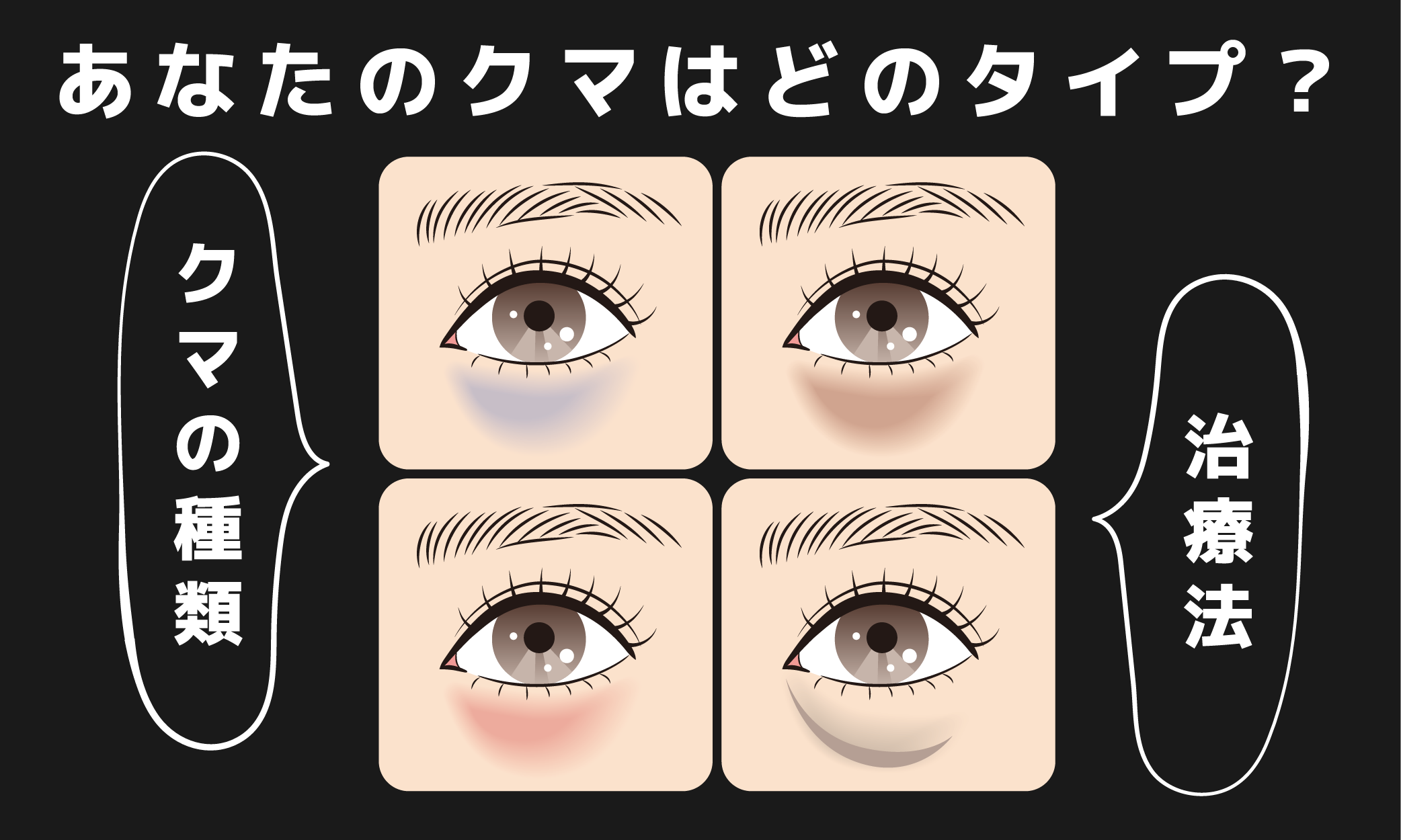 【埼玉でクマ取りするなら】目の下のクマ4種類と治療法を徹底解説｜川口院 佐藤広太郎医師監修