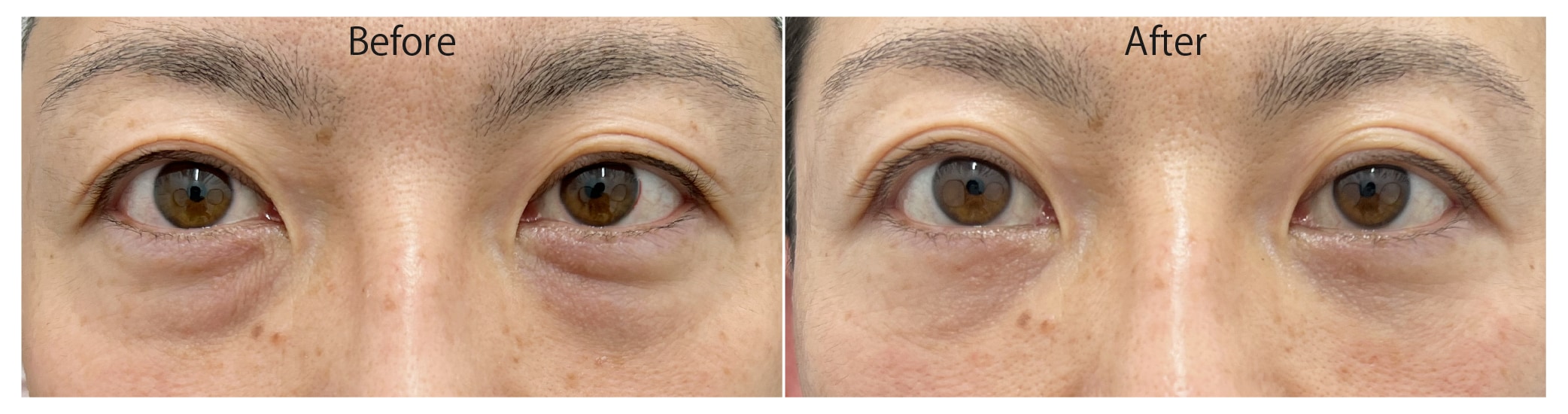 ③ 黒クマ｜影タイプ