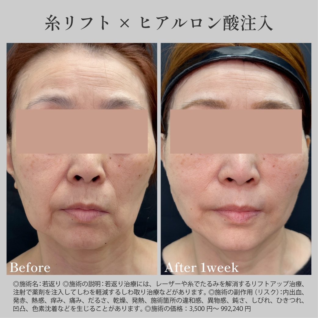 糸リフト×ほうれい線ヒアルロン酸