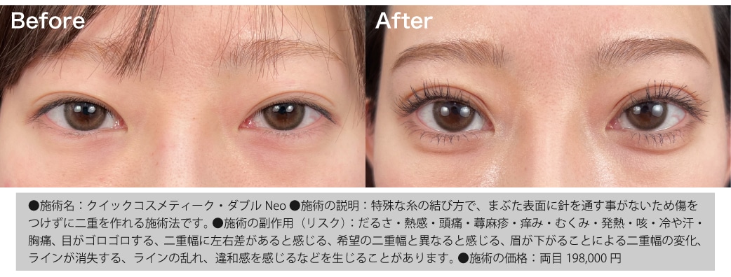 華やかな印象を作る平行型二重の症例