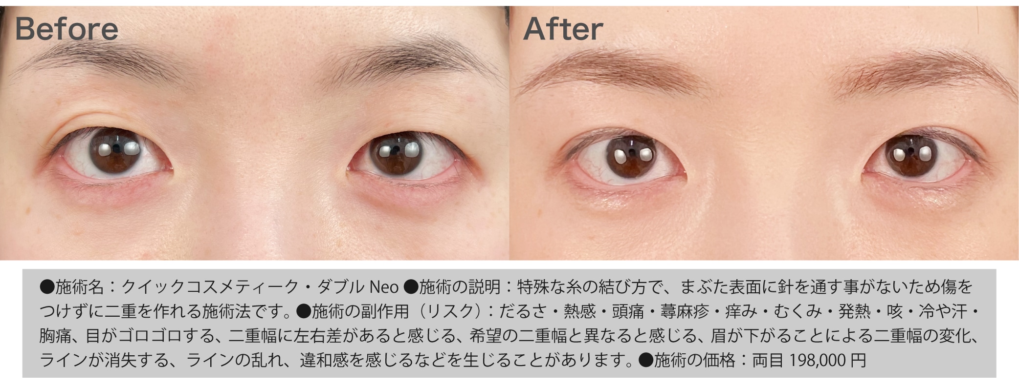 自然な末広型二重の症例