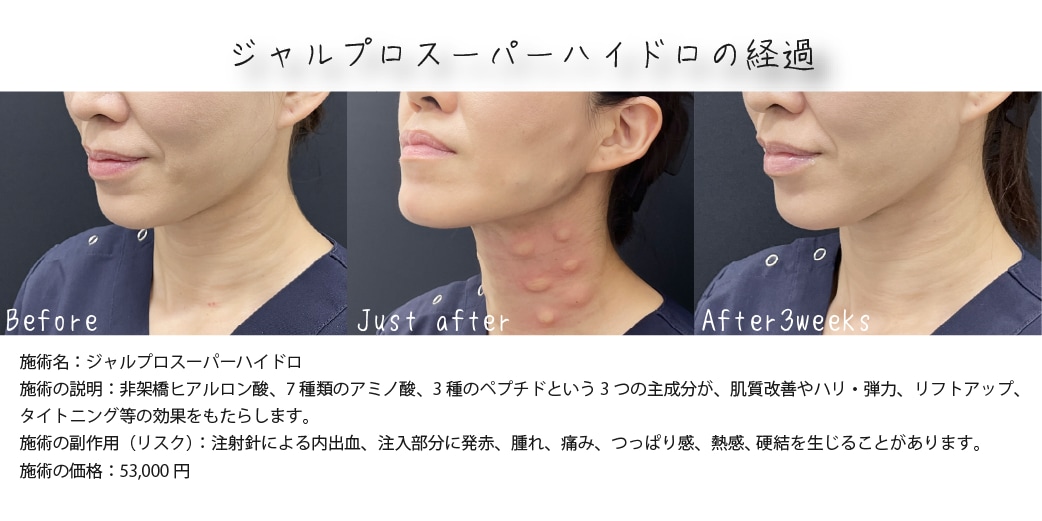 施術後の腫れや内出血の期間と経過