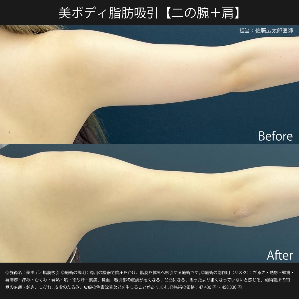 美ボディ脂肪吸引【二の腕＋肩】