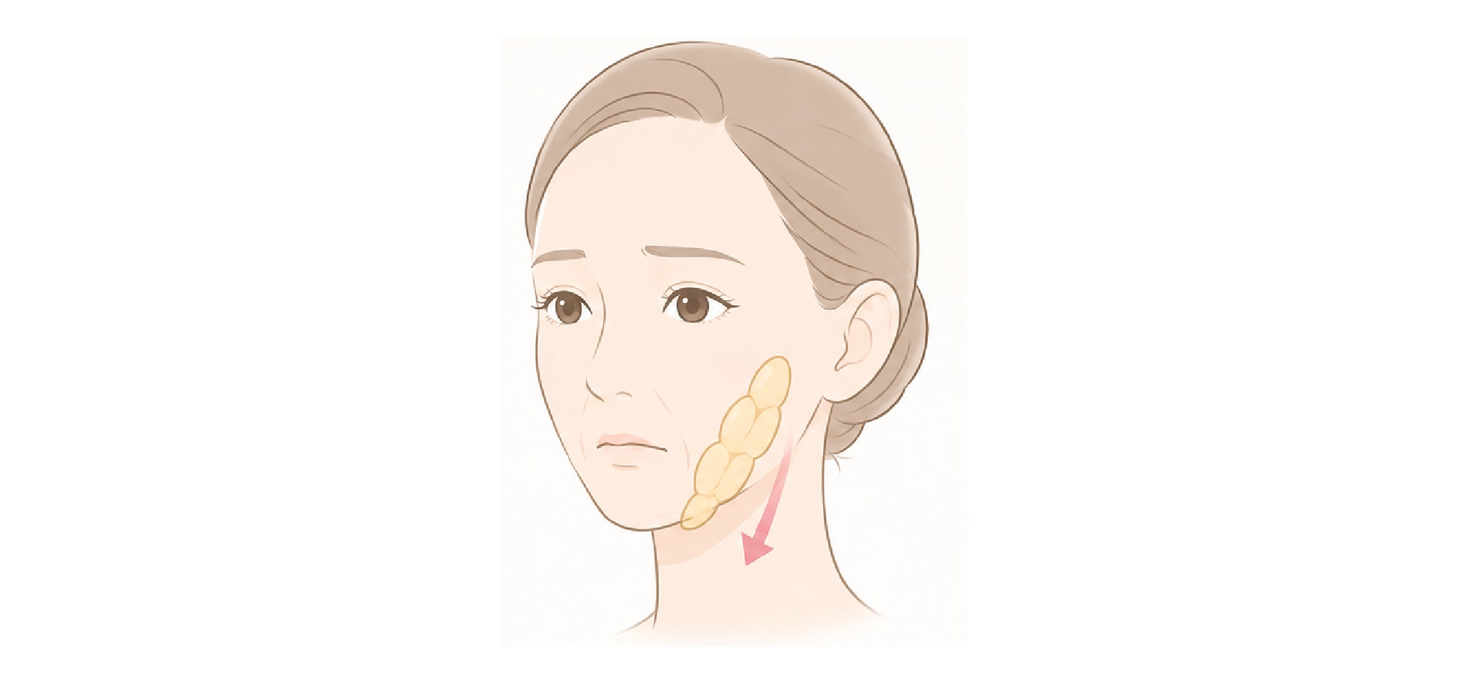 脂肪の下垂