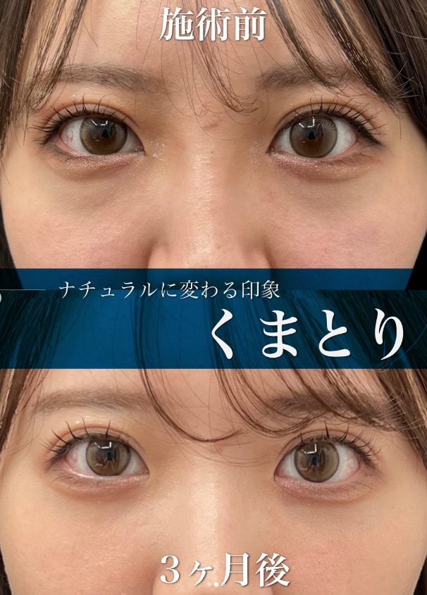 青クマの治し方