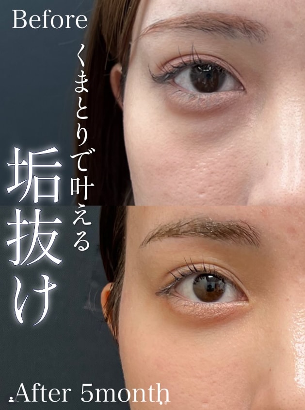 黒クマの治し方