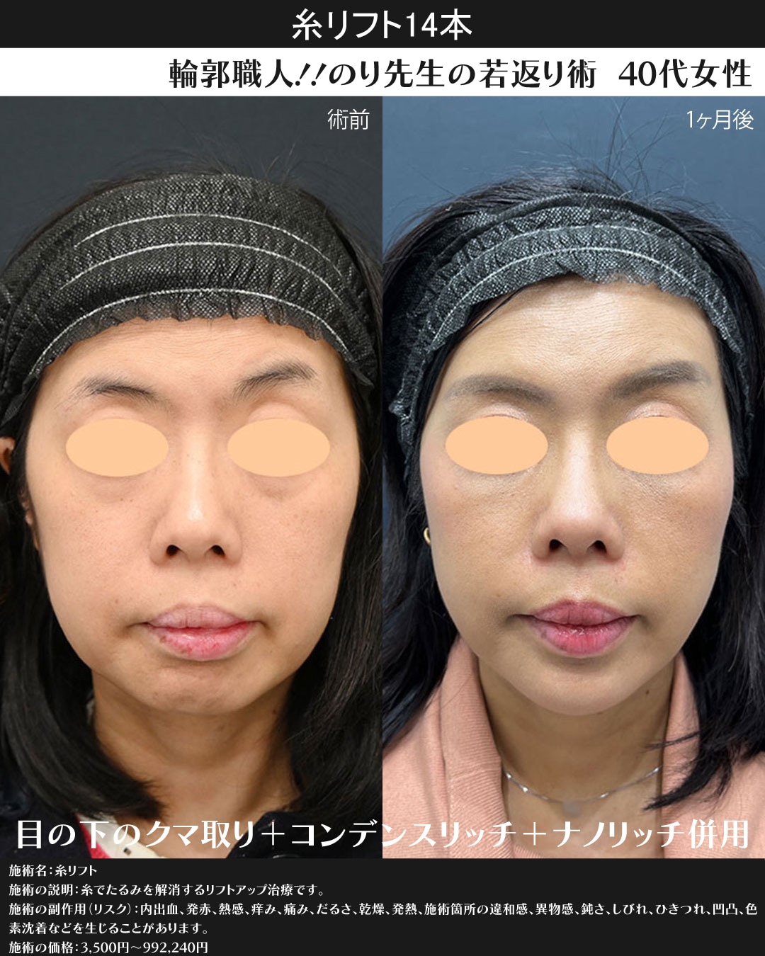 糸リフト14本+アゴのヒアルロン酸