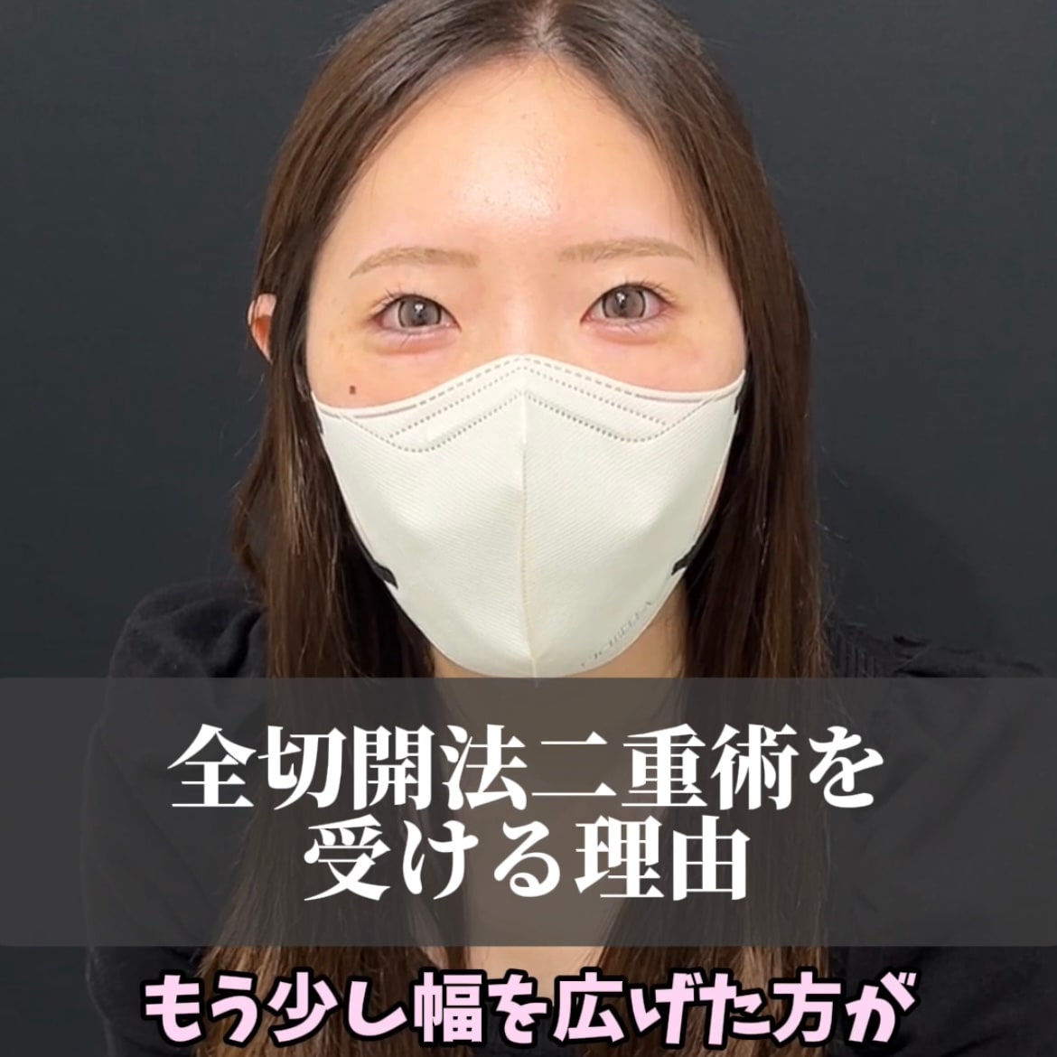 全切開法二重術を受ける理由