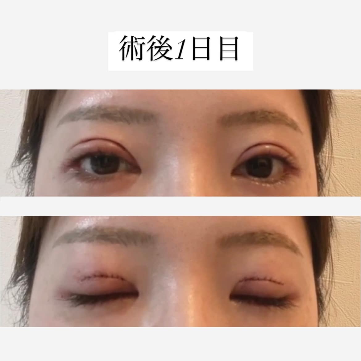 術後1日目