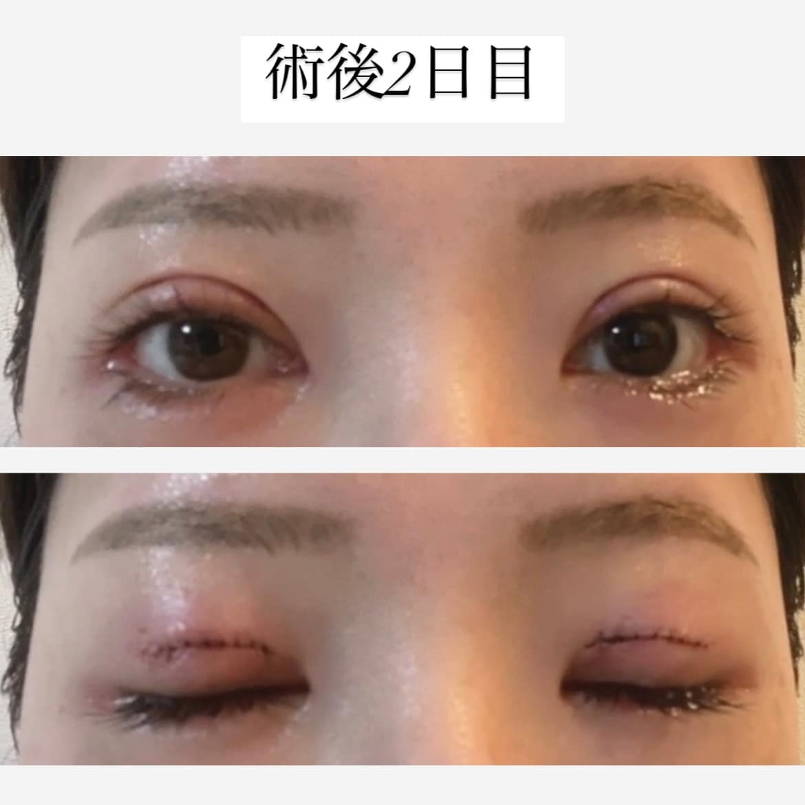 術後2日目