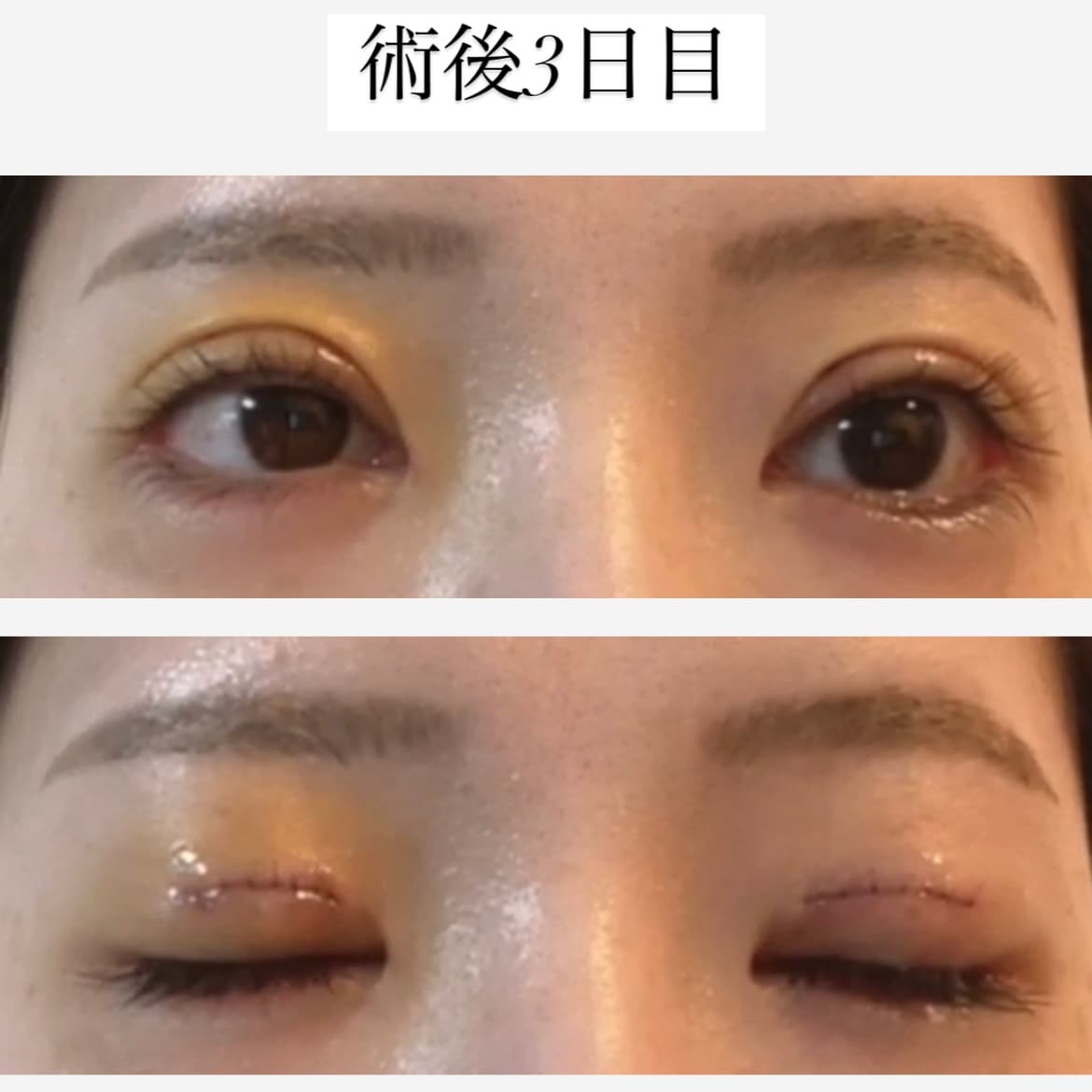 術後3日目